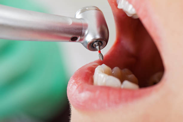 Best Emergency Cosmetic Dentistry (e.g., broken veneers) in Crawfordsville, IN